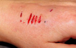 Close up of a dog bite injury on a person's hand.