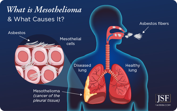 Mesothelioma occurs when asbestos fibers are inhaled & affect the pleural tissue in the lungs.