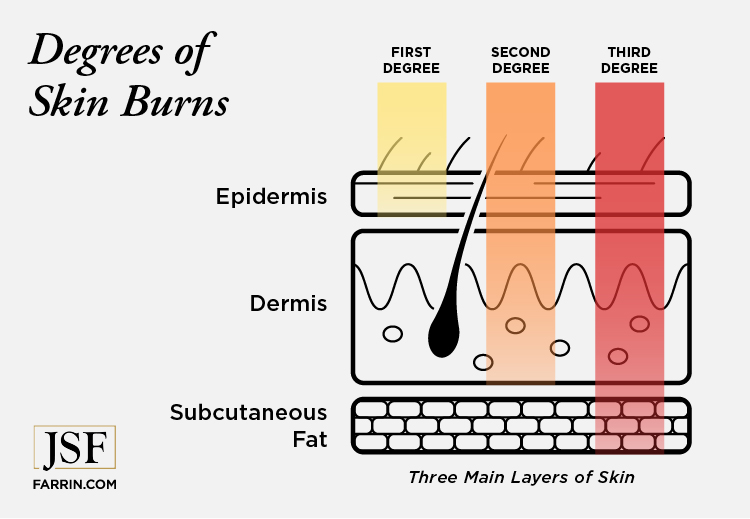 How first, second & third degree burns affect the layers of skin.