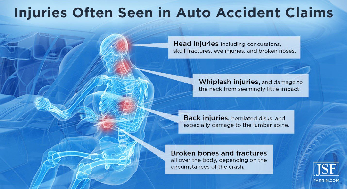 Four common injuries in car accidents, shown on a human skeleton figure.