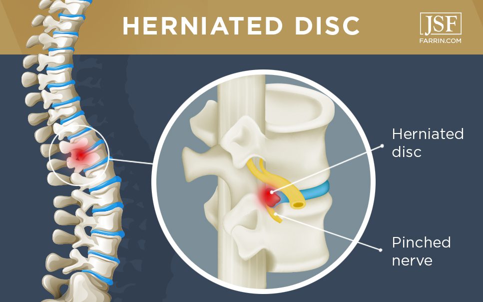 Spine side view showing herniated disc affected area.