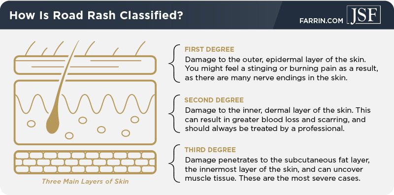 Road rash injuries are classified by how much of the three main layers of skin have been damaged.