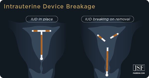 The arms of an IUD can break off during removal, causing internal damage.