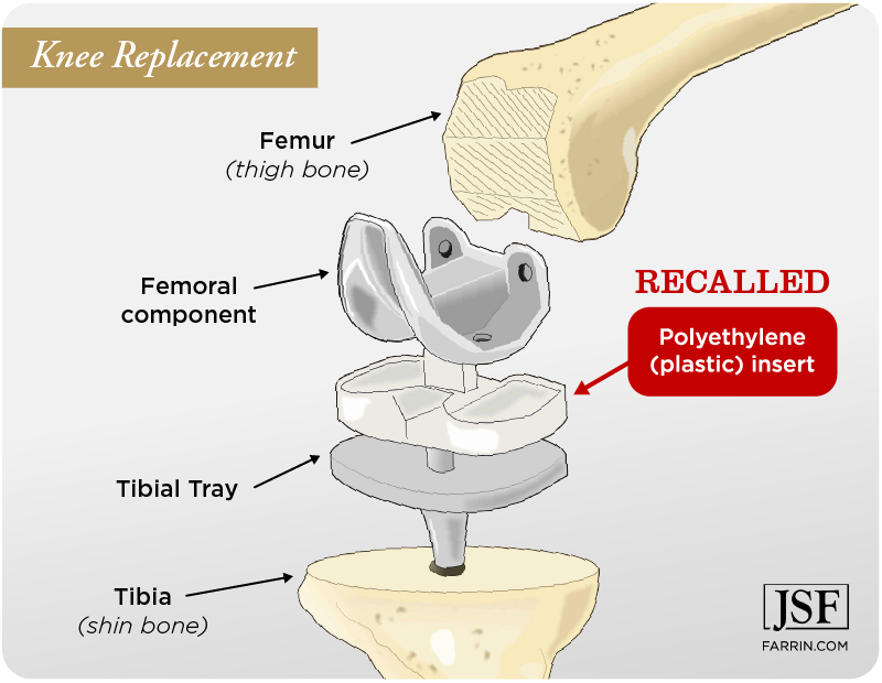 The polyethylene (plastic) section of the Exactech knee replacement is faulty & was recalled.