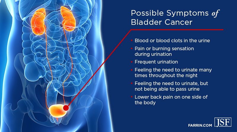 Symptoms of bladder cancer may include frequent and/or painful urination, blood in urine & lower back pain.
