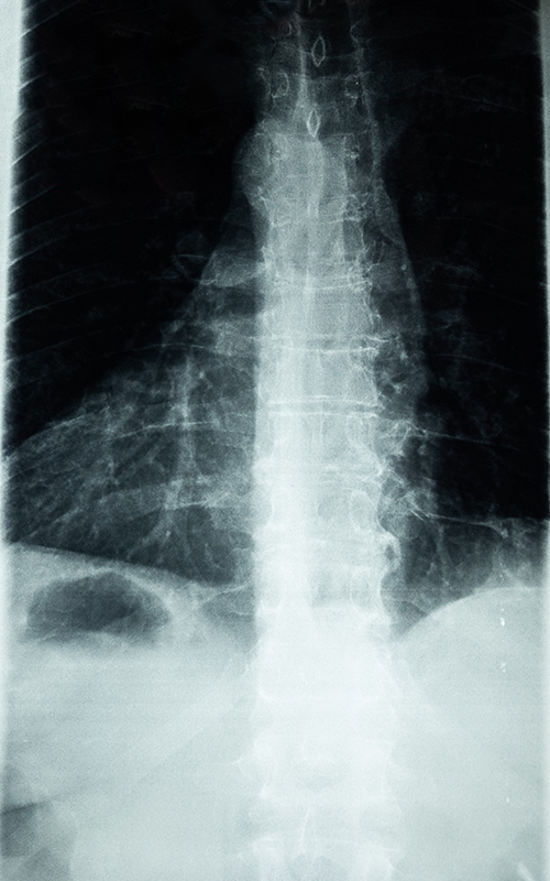 X-ray (radiograph) of a person's pelvis and the lower vertebrae of their spine.