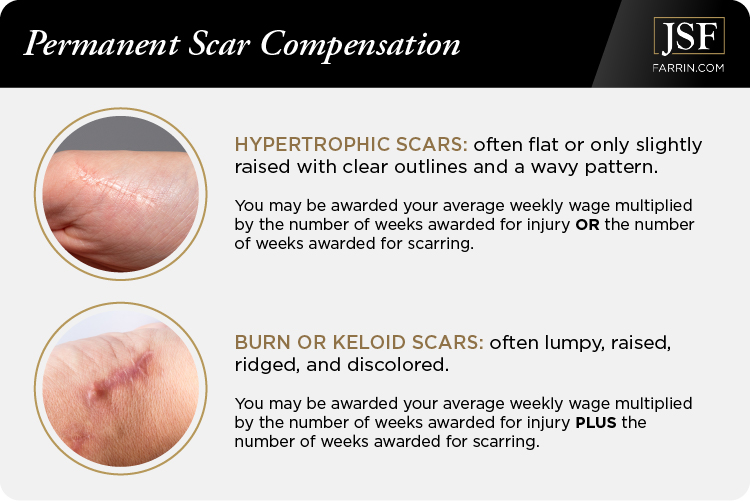Compensation for permanent hypertrophic or burn/keloid scars differs based on the injury.