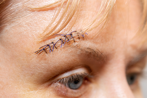Stitches over a woman's eyebrow following an injury.