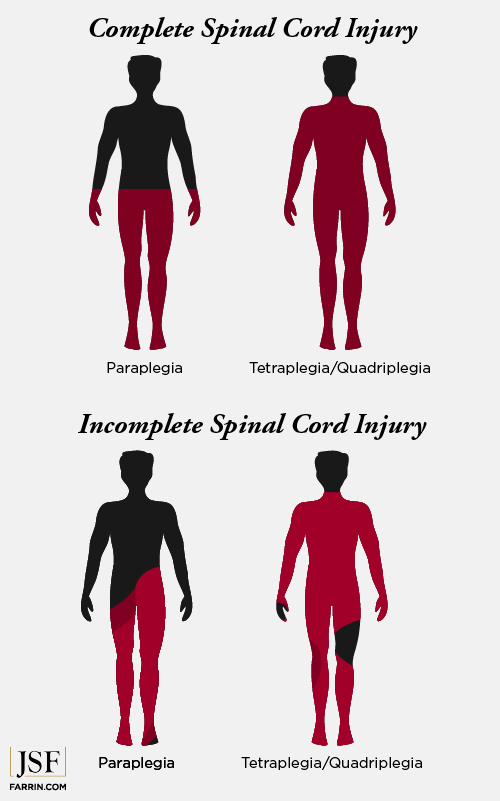 Diagram of complete and incomplete paralysis