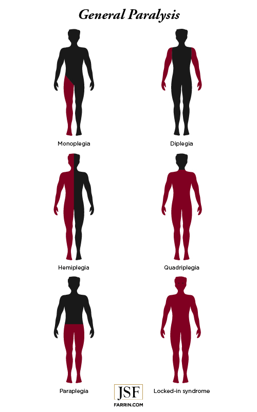 Diagrams of 6 types of general paralysis